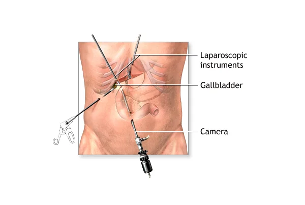 Gallbladder Stone