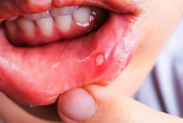 Mouth Ulcer