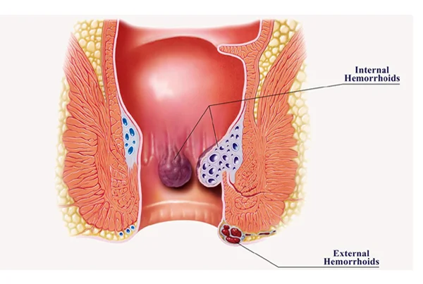 Hemorrhoids