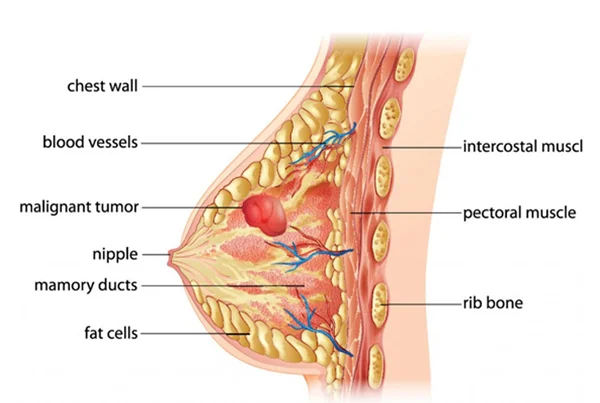 Breast Tumor